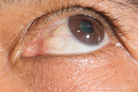 They can appear anywhere but tend to develop around or under the eyes. . Cyst in corner of eye pictures